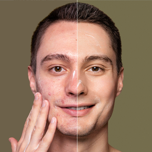 Cilt Tonunu Eşitlemek İçin Pigmentasyon Karşıtı Ürünler